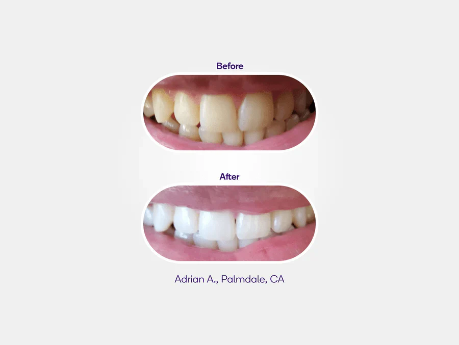 Teeth Veneers